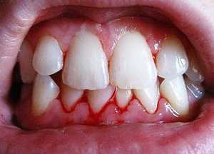 Чистить зубы следует не менее двух минут, также обязательно проводить очистку поверхности языка и щек они тоже являются излюбленным местом размножения бактерий