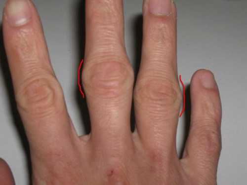 Воспалительный процесс в суставной ткани кистей рук может развиться по таким причинам, как получение механических травм чрезмерная физическая нагрузка изменения, связанные с возрастным истончением суставной и хрящевой ткани развитие патологий, поражающих суставы