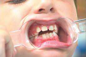 При операции по протезированию или имплантации зубов ноября